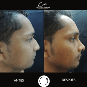 cirugía de nariz precio – Dr. Carlos Merlano
