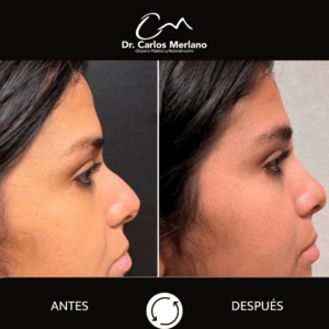 cirugía de nariz – Dr. Carlos Merlano