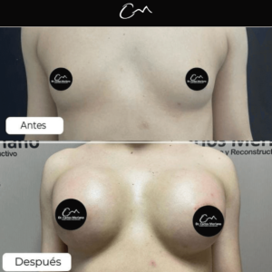 cirugía de senos – Dr. Carlos Merlano