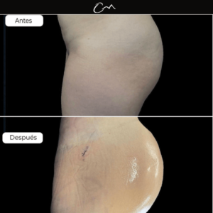 gluteoplastia antes y después - Dr. Carlos Merlano