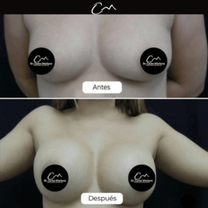implantes de senos – Dr. Carlos Merlano