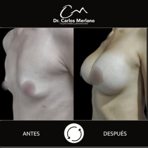mamoplastia de aumento – Dr. Carlos Merlano
