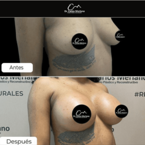 mamoplastia de reducción – Dr. Carlos Merlano