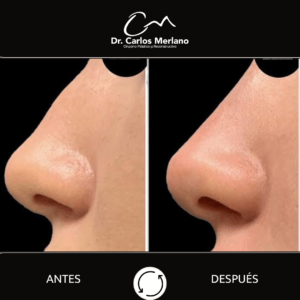 operación de nariz precio – Dr. Carlos Merlano