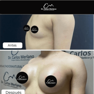 pecho operado natural – Dr. Carlos Merlano
